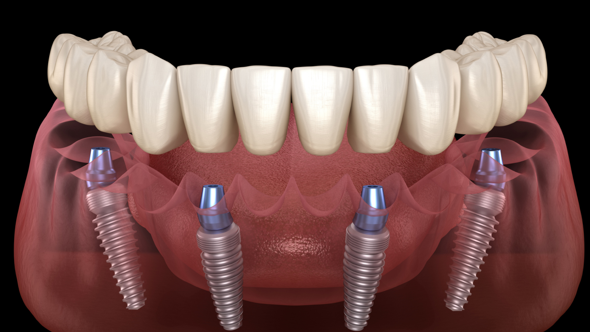 https://dental.netizens.dev/wp-content/uploads/2025/05/06-guide-all-on-4.jpg