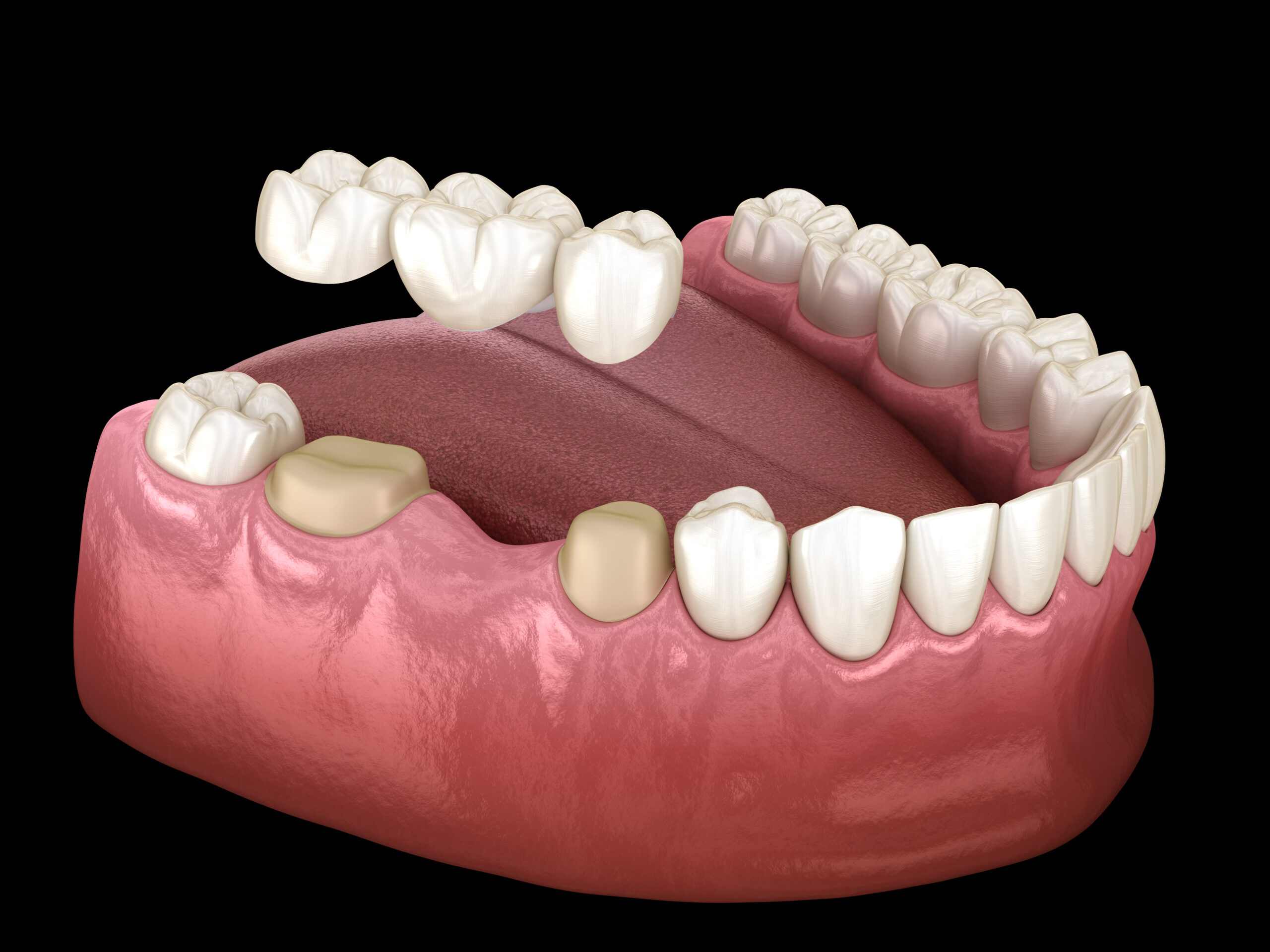 https://dental.netizens.dev/wp-content/uploads/2025/05/Dental-Bridges-scaled-1.jpg