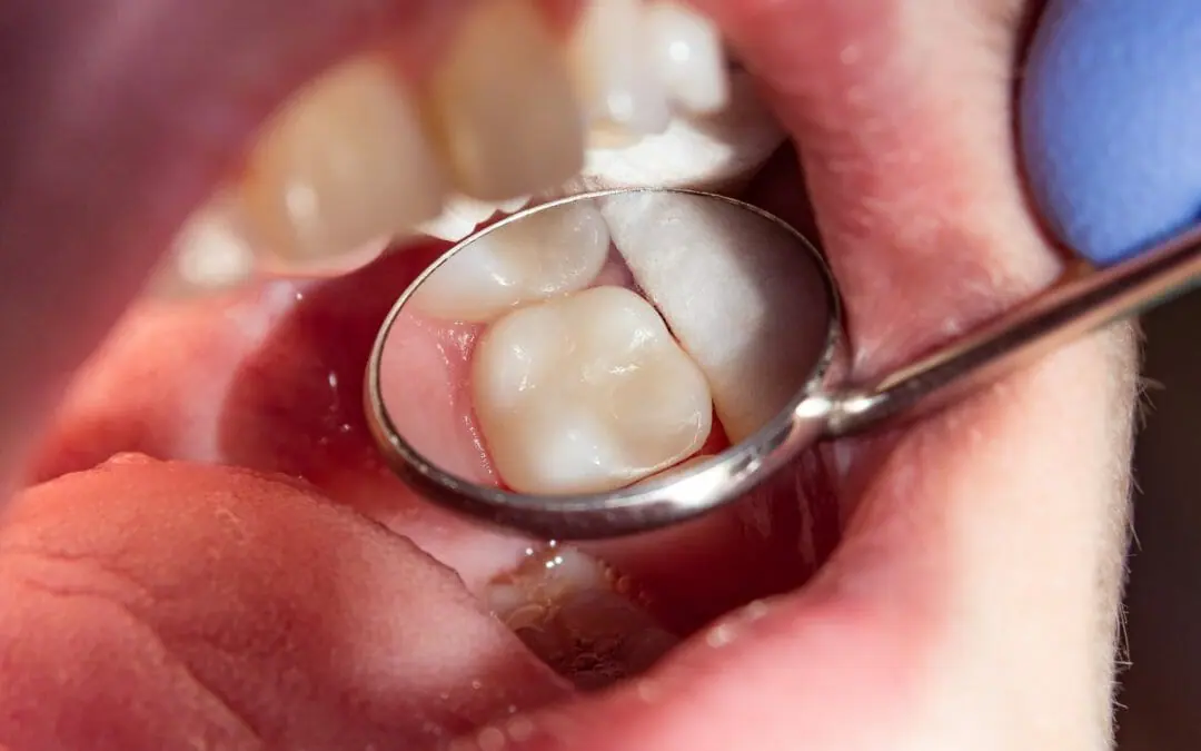 https://dental.netizens.dev/wp-content/uploads/2025/05/filling.webp