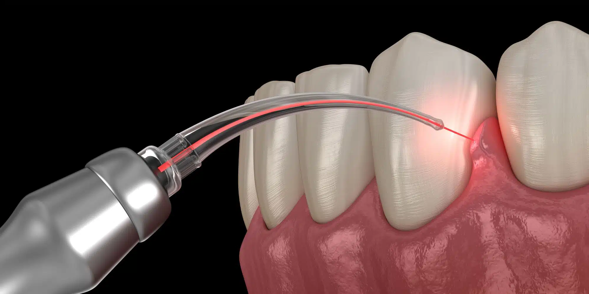 https://dental.netizens.dev/wp-content/uploads/2025/05/lanap-treatment.jpg.webp
