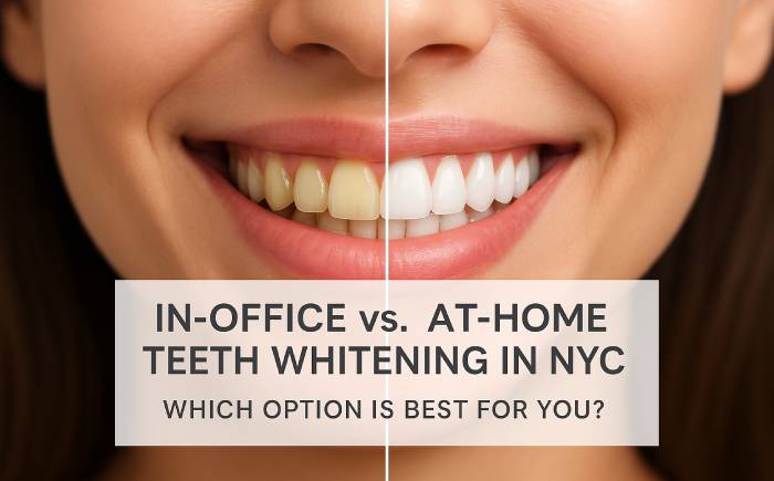 In-Office vs At-Home Teeth Whitening in NYC