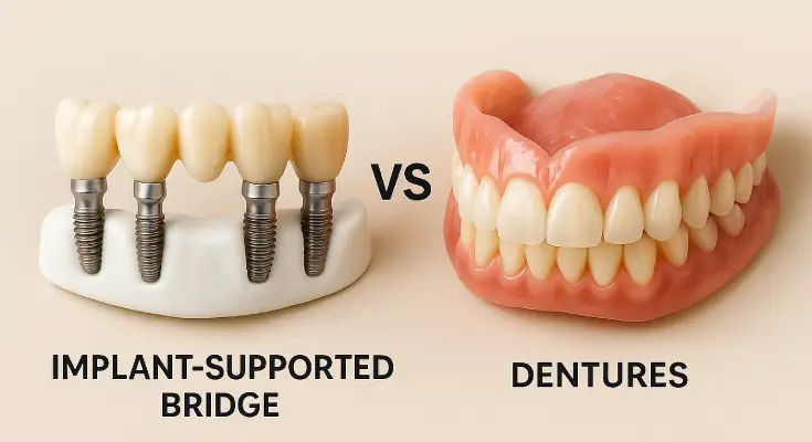 Implant-supported bridges vs dentures