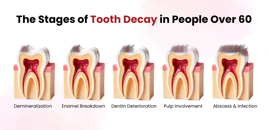 Different stages of tooth decay