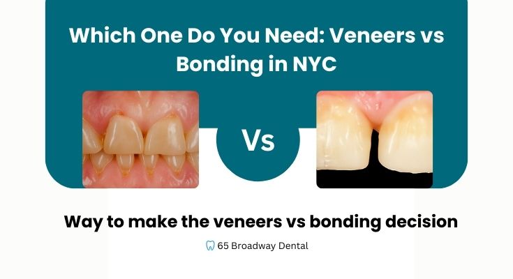 Veneers vs Bonding in NYC: Which One Is Right for You?