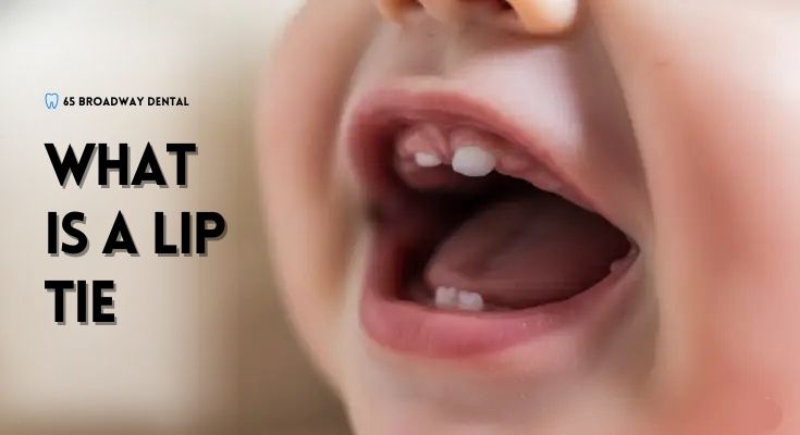 What Is a Lip Tie? Causes, Signs, and Simple Ways to Help Your Child